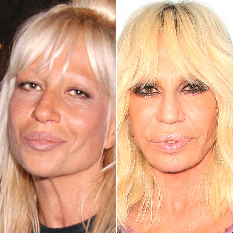 Donatella versace plastic surgery
