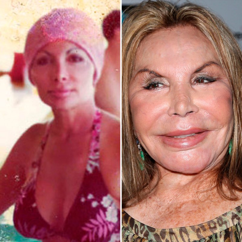 Elsa patton plastic surgery