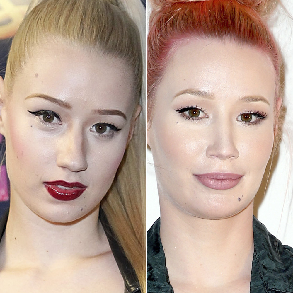 Iggy azalea plastic surgery