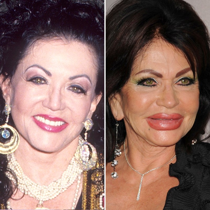 Jackie stallone plastic surgery