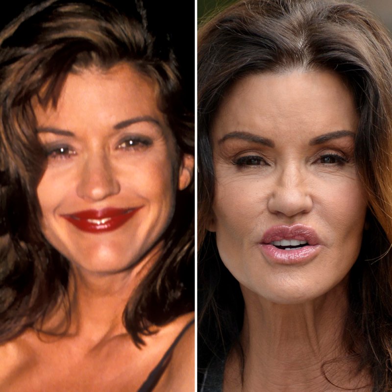 Janice dickinson plastic surgery