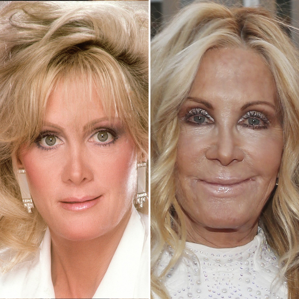 Joan van ark plastic surgery