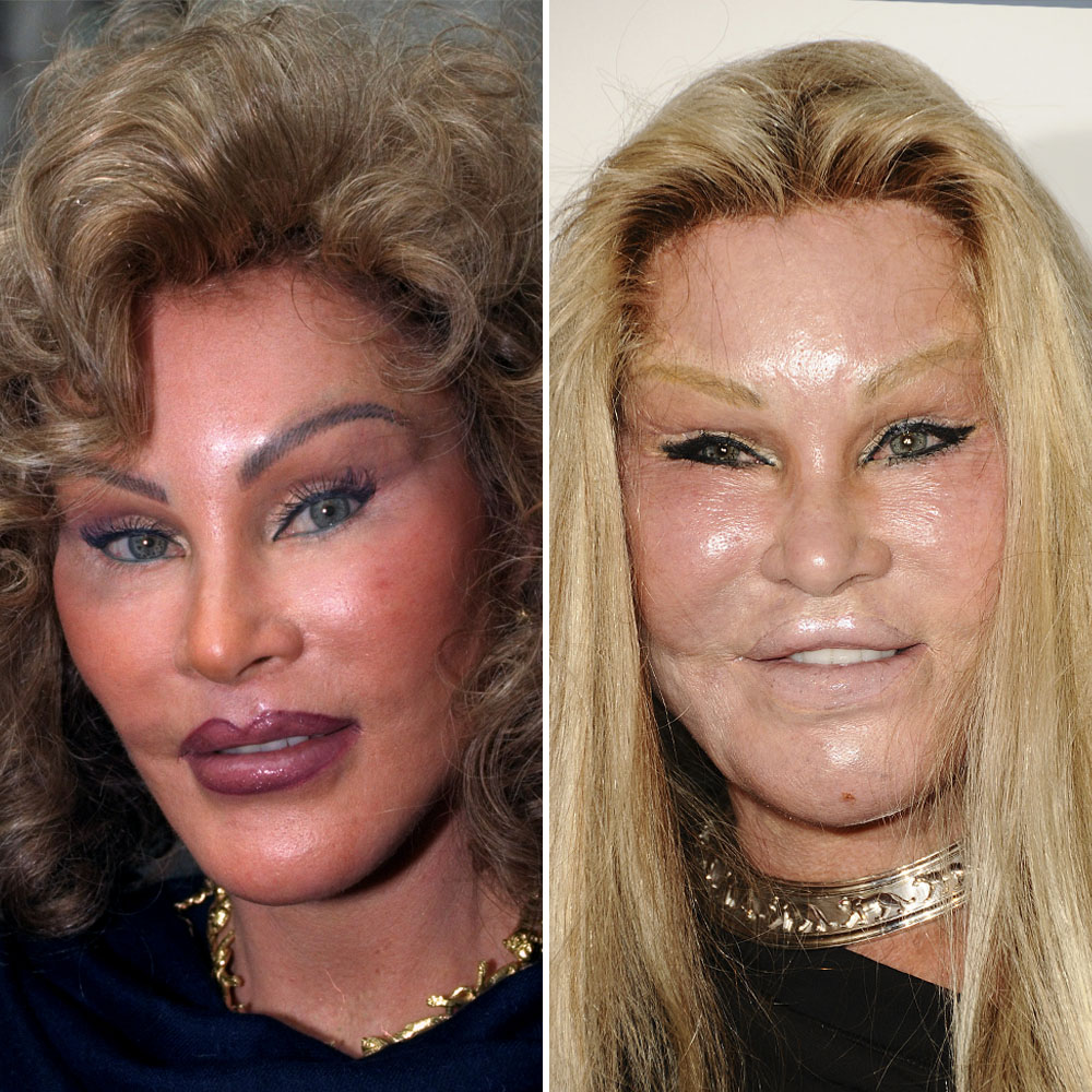 Jocelyn wildenstein plastic surgery