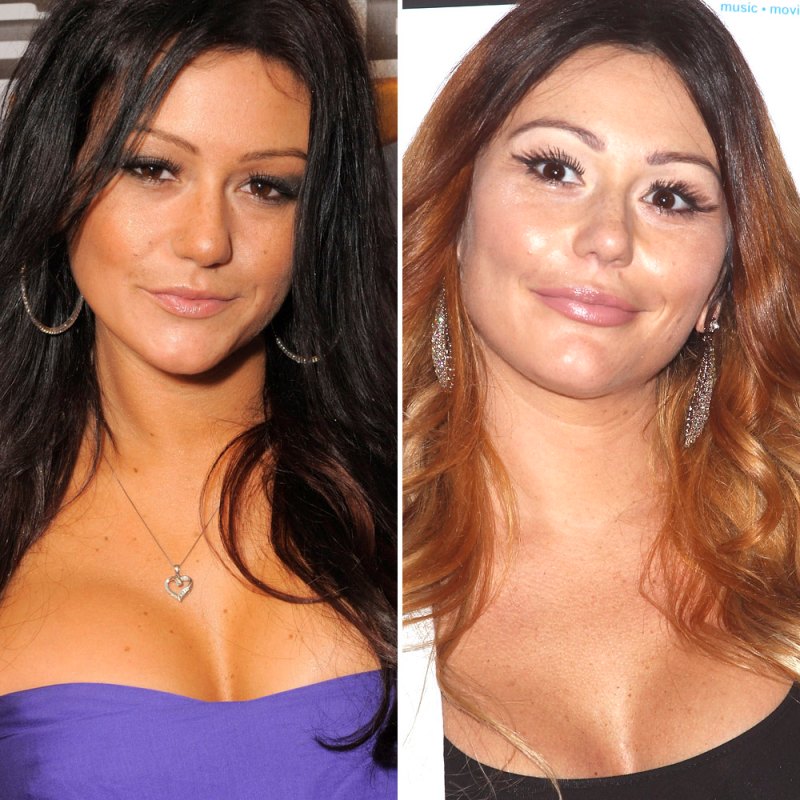 Jwoww plastic surgery