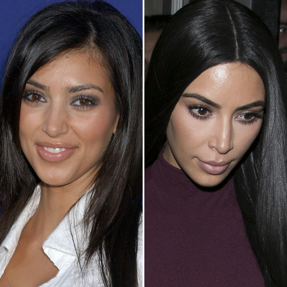 Kim kardashian nose job