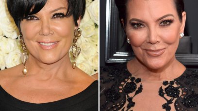Kris jenner facelift surgery