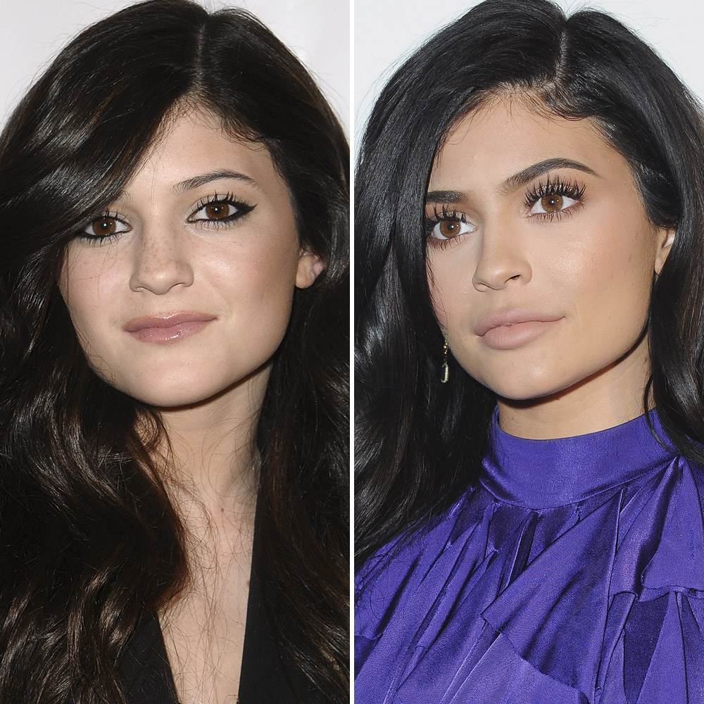 Kylie jenner nose job