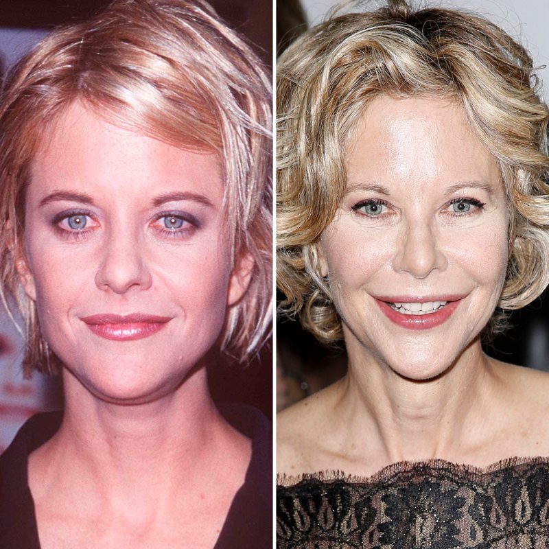 Meg ryan plastic surgery