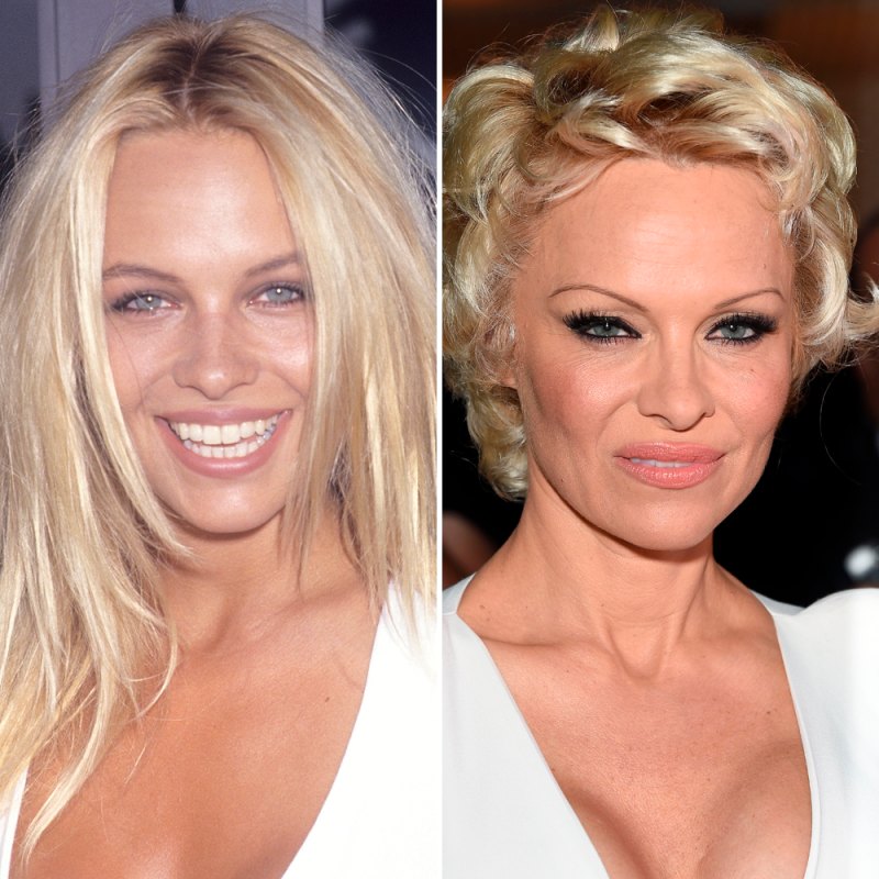Pamela anderson plastic surgery