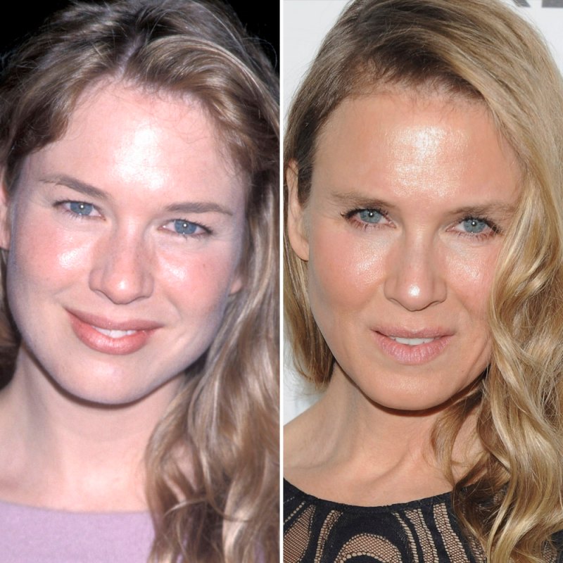 Rene zellweger plastic surgery