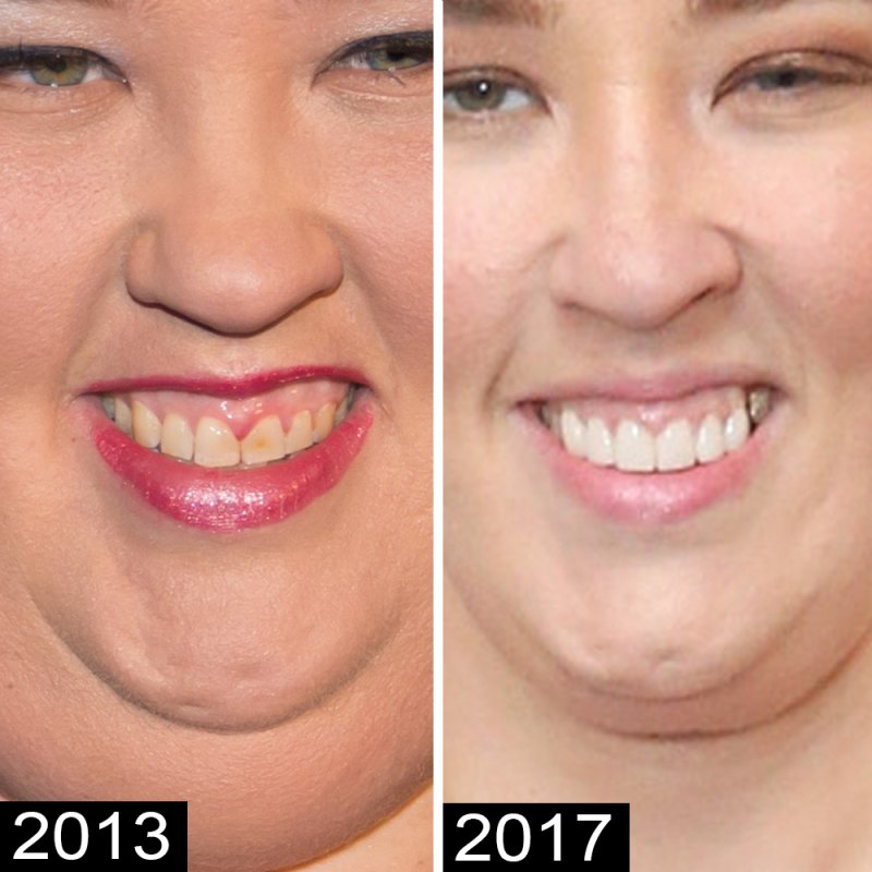 Mama june teeth 2