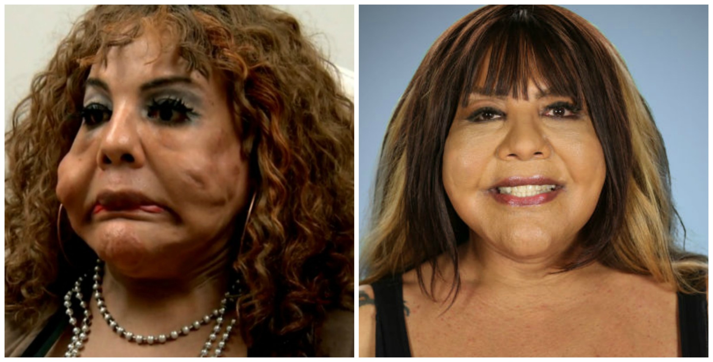 See the Most Extreme Plastic Surgery Transformations on Botched!