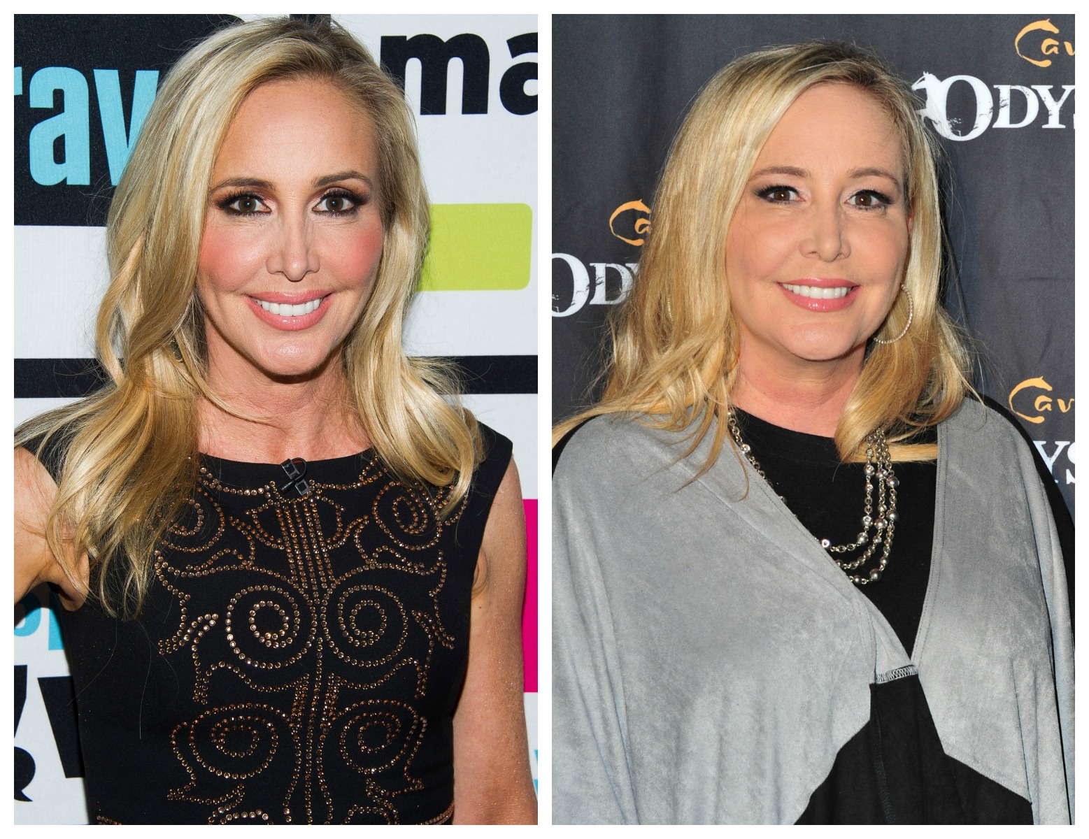 Shannon beador plastic surgery 1