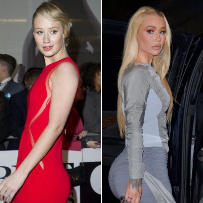 Iggy Azalea Has Been Honest About Plastic Surgery: See Her Before and After Transformation Photos