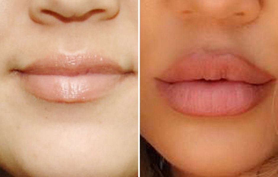 Khloe kardashian lips