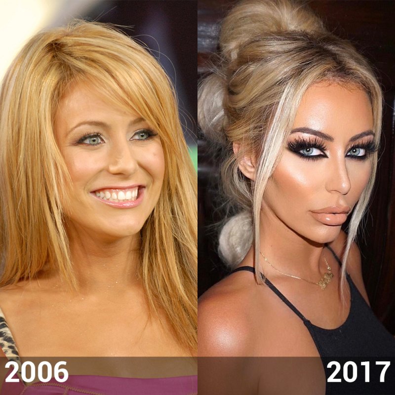 Aubrey oday before plastic surgery lips