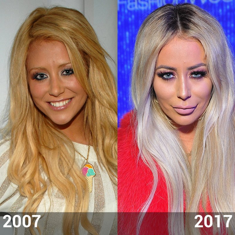 Aubrey oday before plastic surgery nose