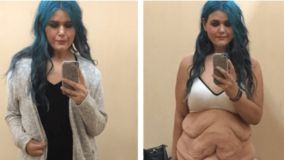 Excess skin after weight loss