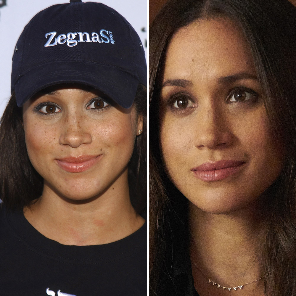 meghan markle nose job getty images