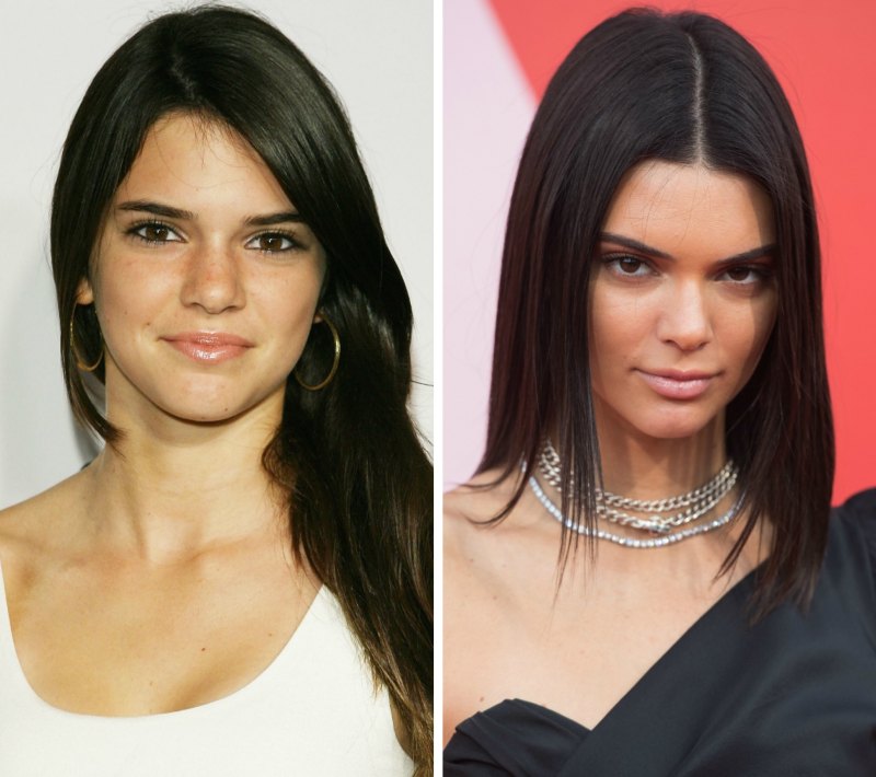 Kendall jenner before and after plastic surgery