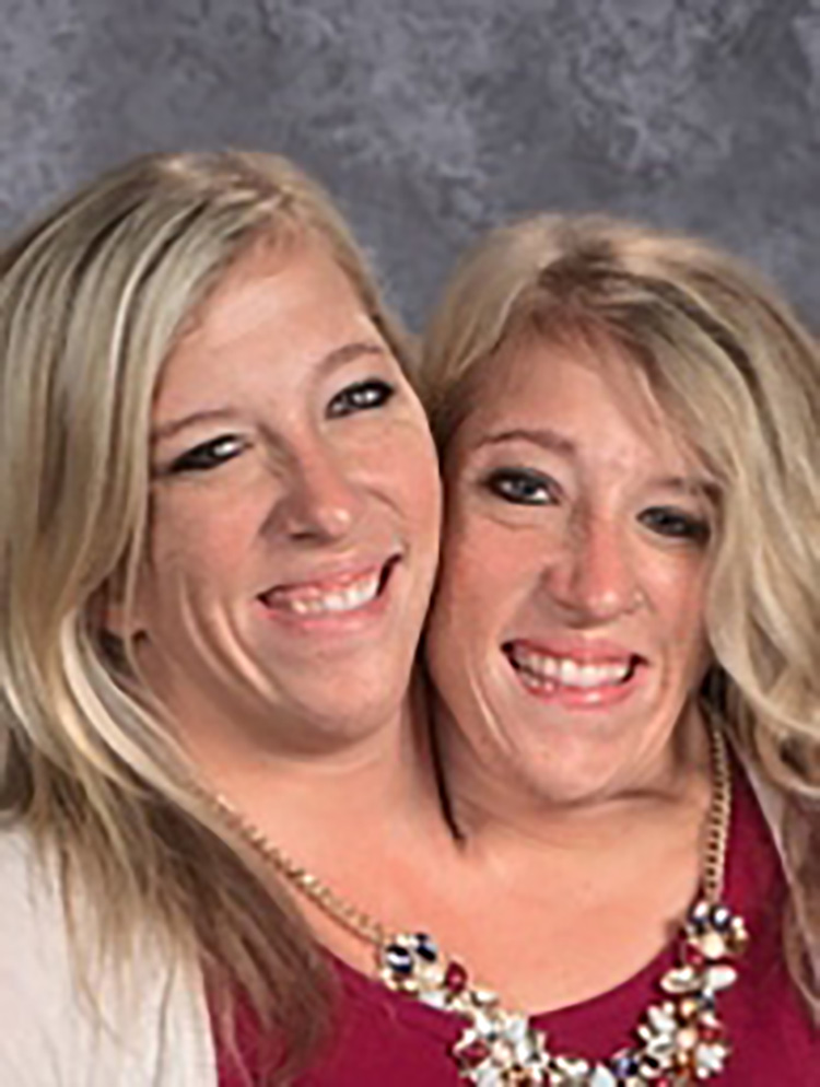 Are cojoined twins Abby and Brittany Hensel married in 2022?