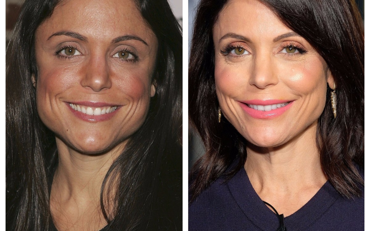 Bethenny Frankel Plastic Surgery The RHONY Star Has Admitted to Botox