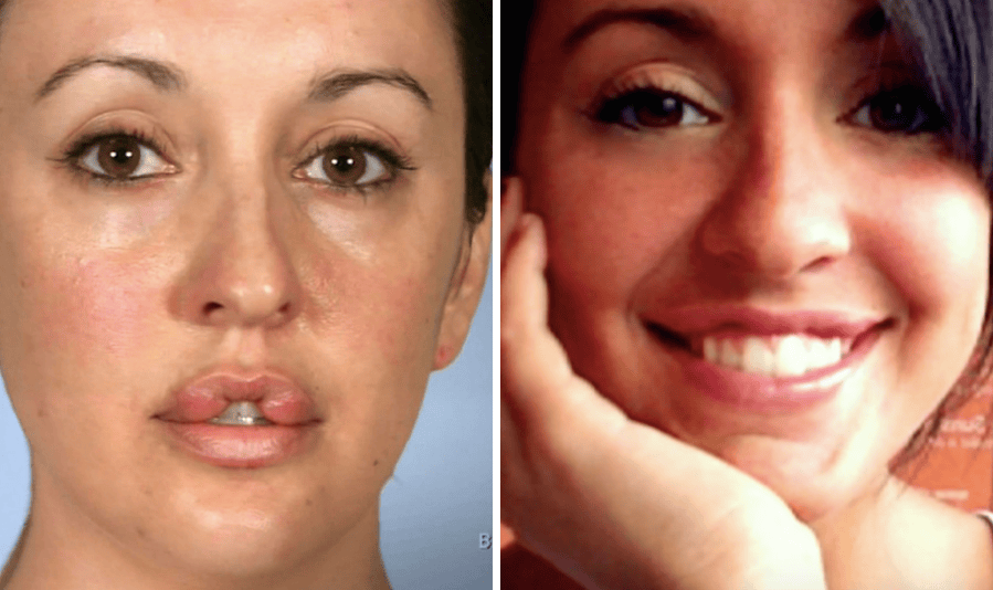 Botched Rajee The Most Shocking 'Botched' Plastic Surgery Transformations | Life & Style