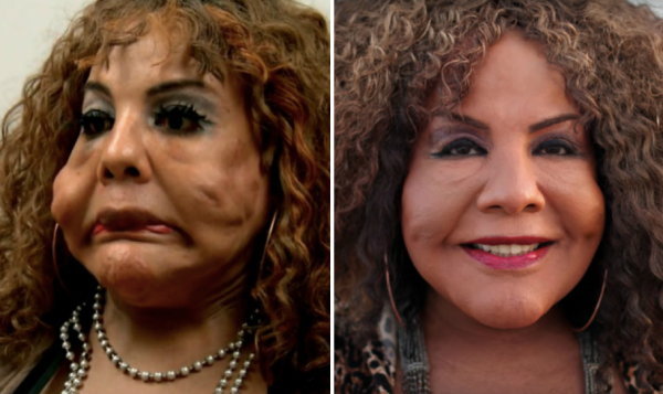 The Most Shocking 'Botched' Plastic Surgery Transformations