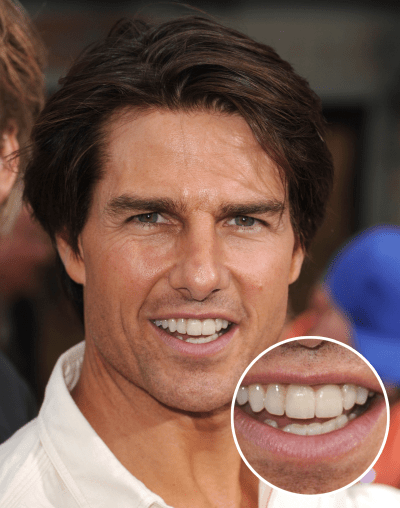 tom cruise middle tooth