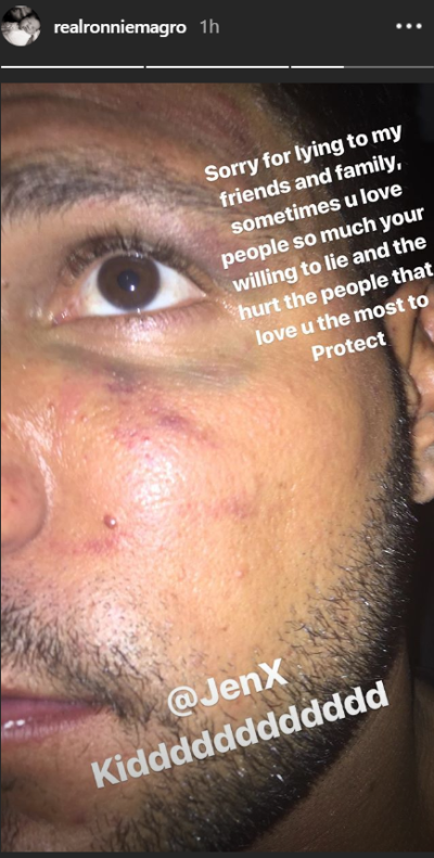 ronnie-magro-black-eye