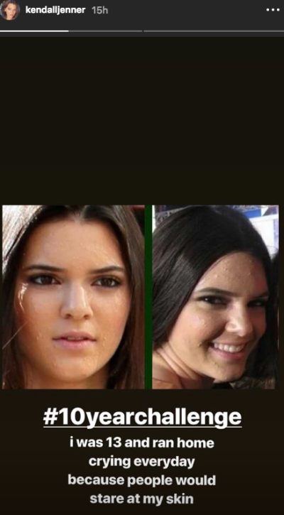 Kendall Jenner 10 year challenge acne