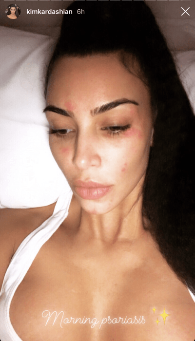 kim-kardashian-psoriasis
