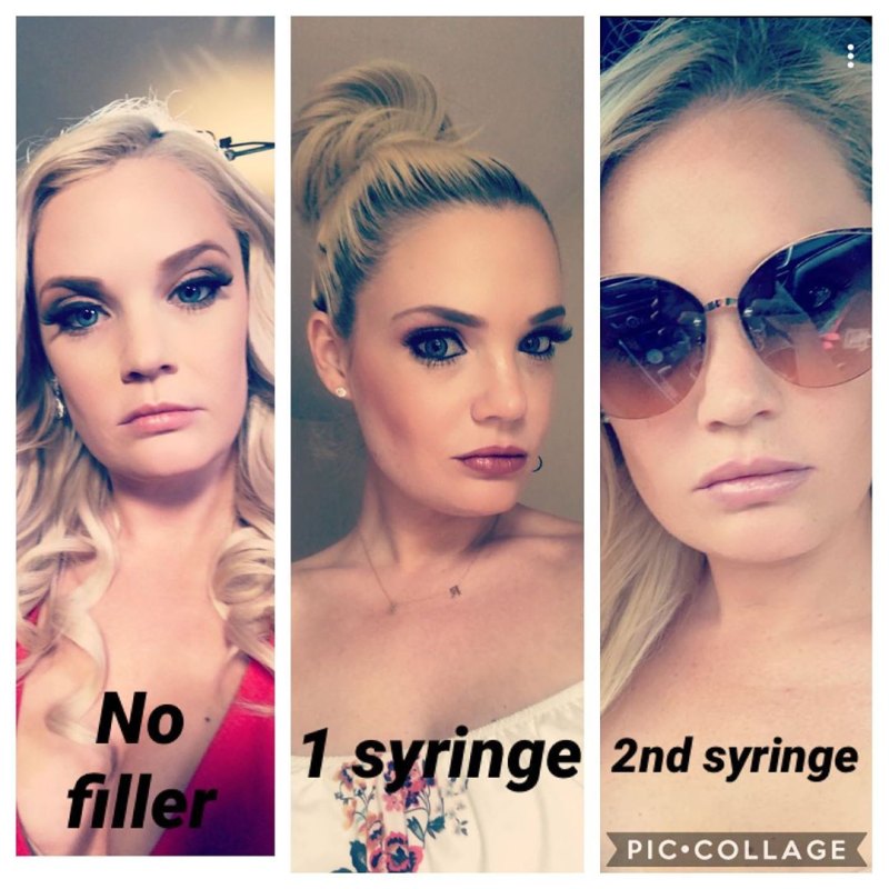 90 Day Fiance Ashley Martson Lip Injections Botox