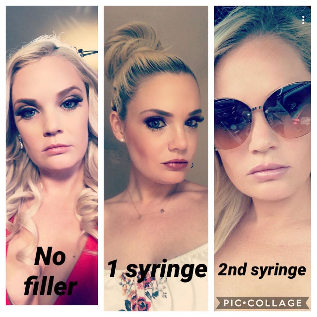 90 Day Fiance Ashley Martson Lip Injections Botox