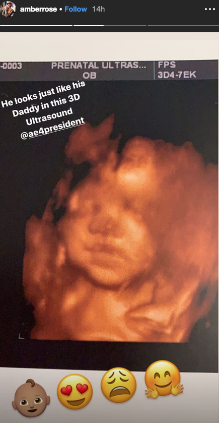 Amber Rose's Baby in 3D Ultrasound 