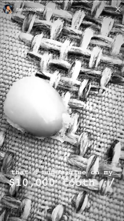 Tana Mongeau Loses a Veneer