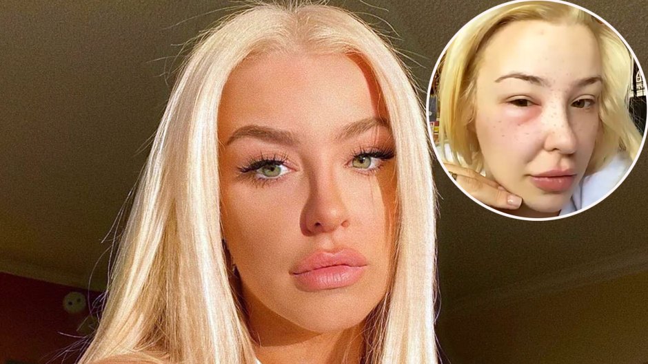 Tana Mongeau Shares Throwback Selfies While Suffering From a Swollen Eye