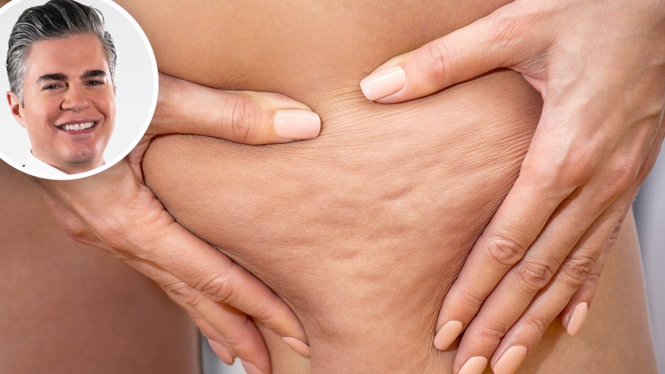 How to Get Rid of Cellulite Experts Weigh In on Two Injectable