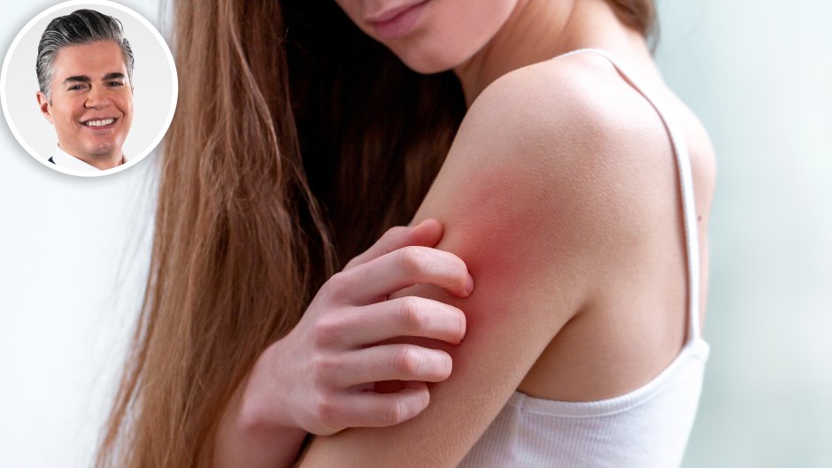 How to Get Rid of Heat Rash According to a Dermatologist
