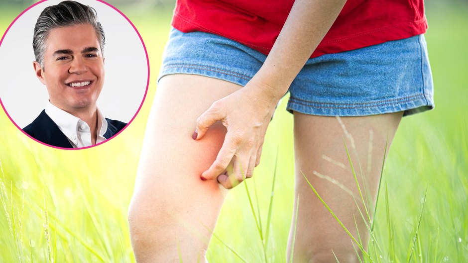 5 Expert Tips to Heal and Prevent Skin Chafing This Summer