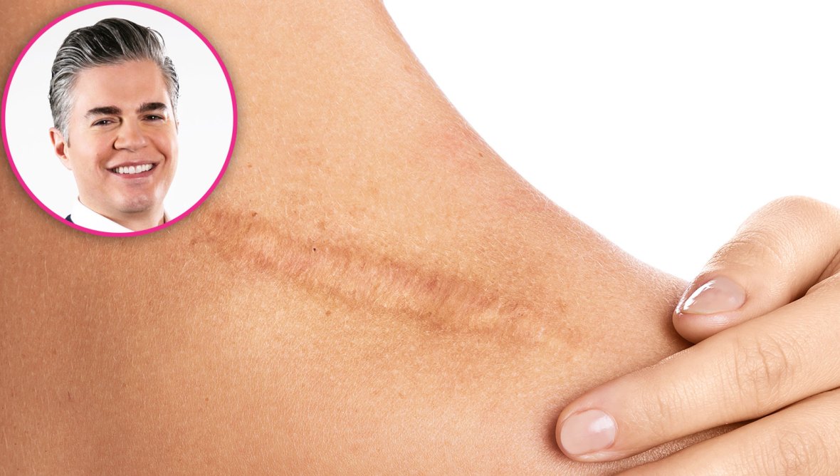 How to Reduce and Lighten Scars