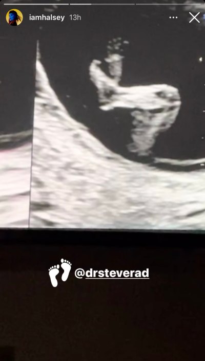 halsey-ultrasound-pregnant-ig