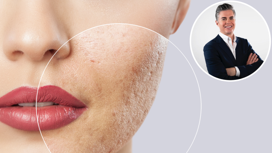 Skin Check-In With Dr. Will: Top Dermatologists Reveal How to Avoid Acne Scarring