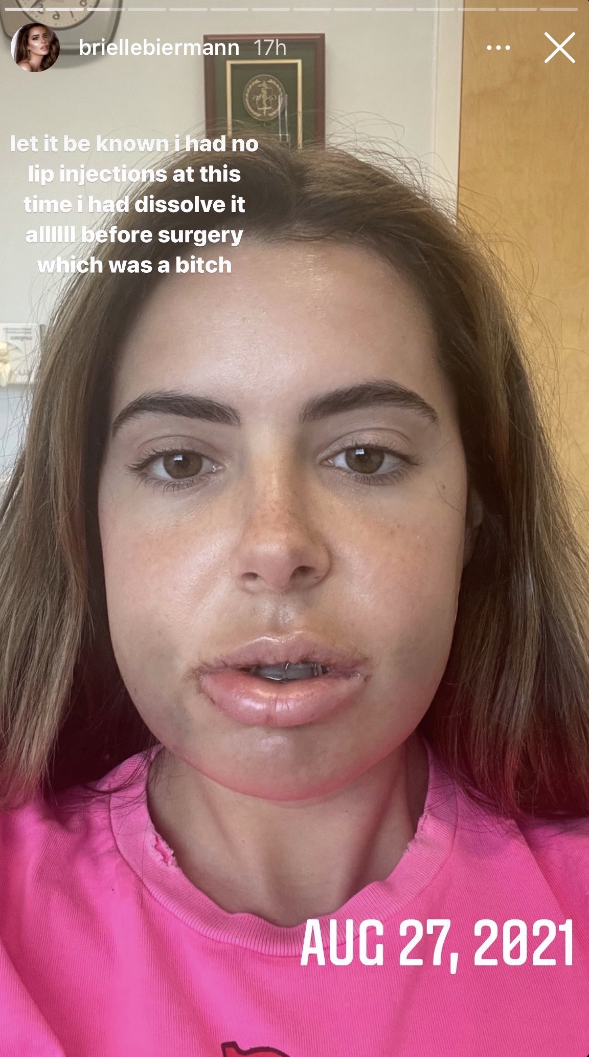 Brielle Biermann's Double Jaw Surgery: Before-and-After Photos | Life ...
