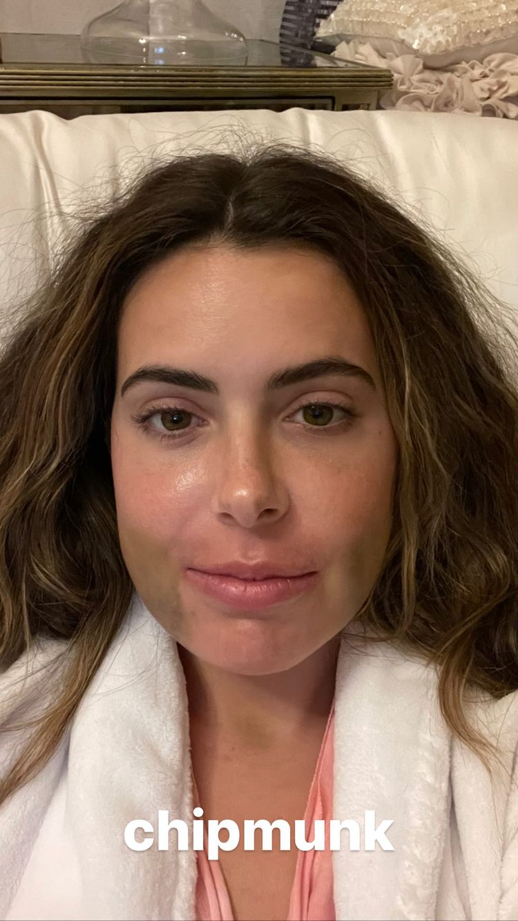 Brielle Biermann's Double Jaw Surgery: Before and After Photos 5