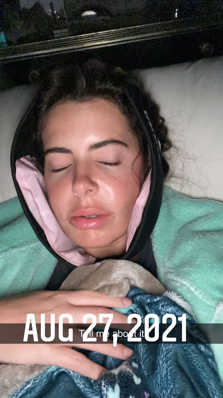 Brielle Biermann's Double Jaw Surgery: Before and After Photos 4