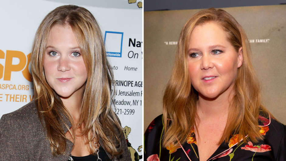 Did Amy Schumer Get Plastic Surgery? Transformation Photos
