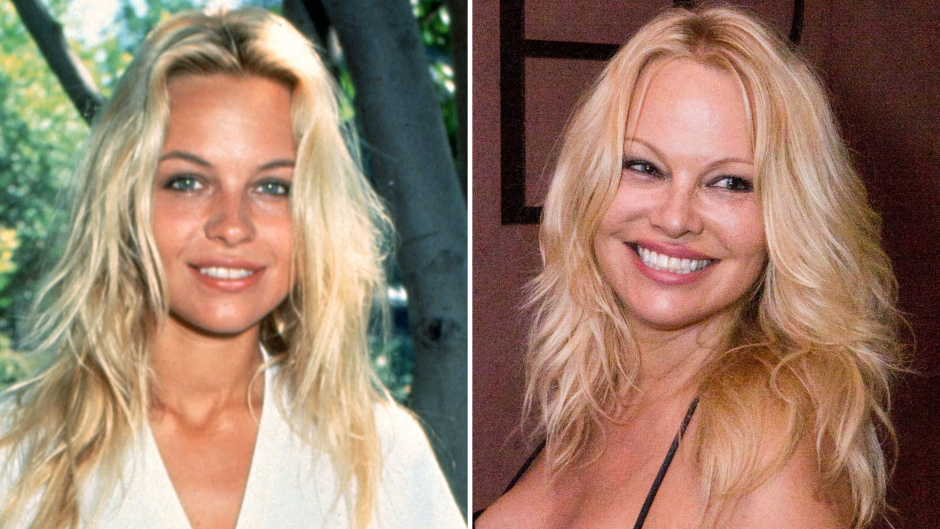 Has Pamela Anderson Gotten Plastic Surgery? See the 'Baywatch' Alum Then and Now!