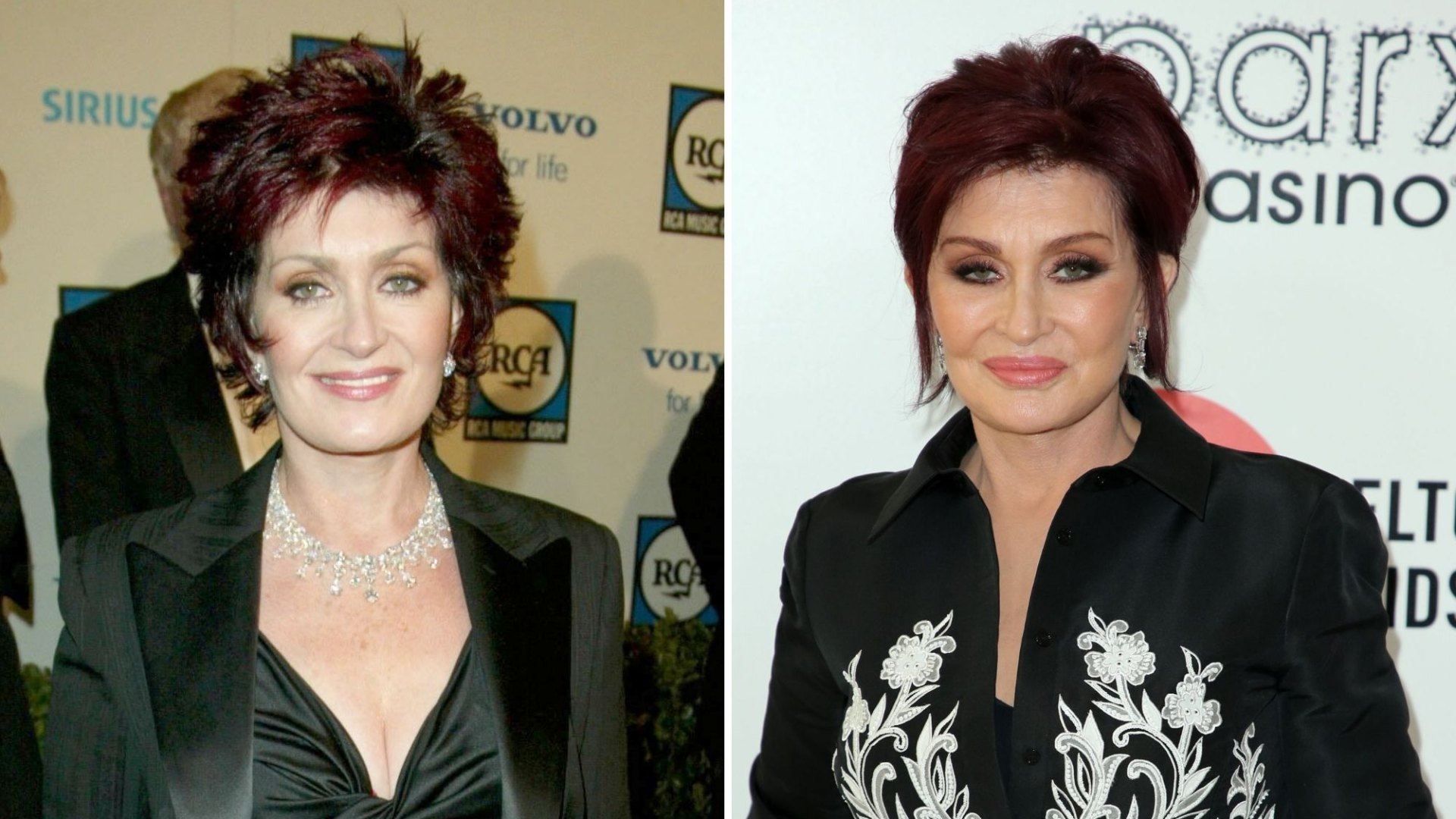 Sharon Osbourne Plastic Surgery Facelift Before After Photo Life sharon-osbourne-plastic-surgery-facelift-before-after-photo-life