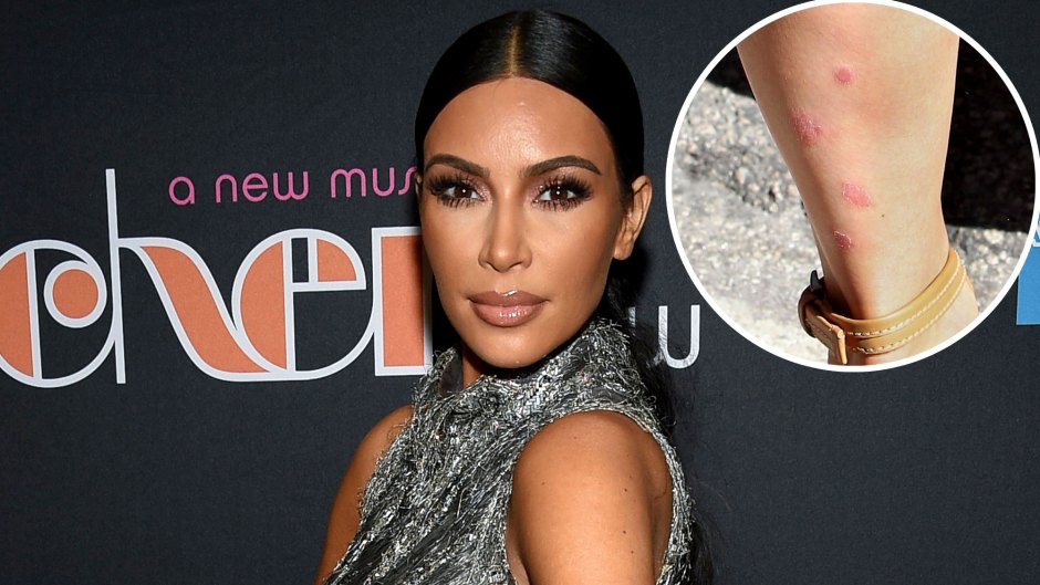 What Does Kim Kardashian's Skin Look Like With Psoriasis? Pictures of Breakouts She's Shared